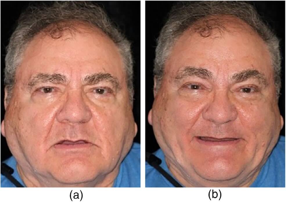 Preoperative maxillary atrophic ridge frontal and occlusal views