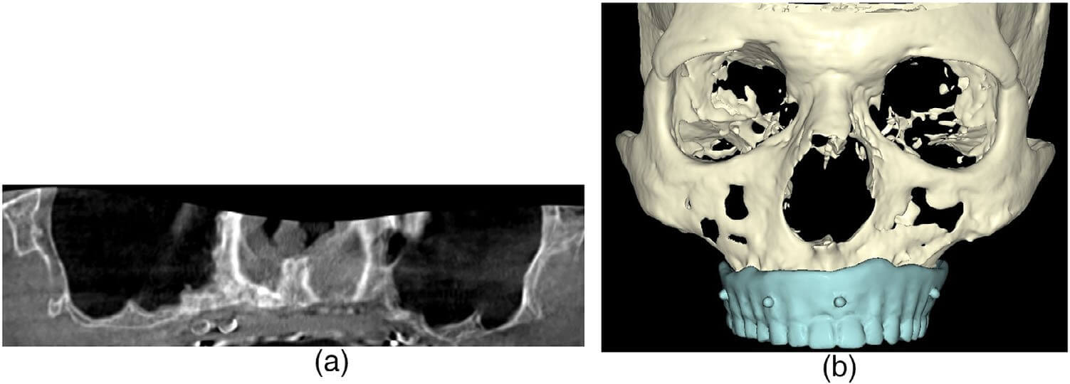 Preoperative panoramic radiograph and 3D reformation