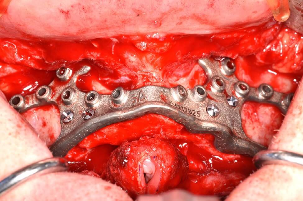 Titanium bone reduction guide in place