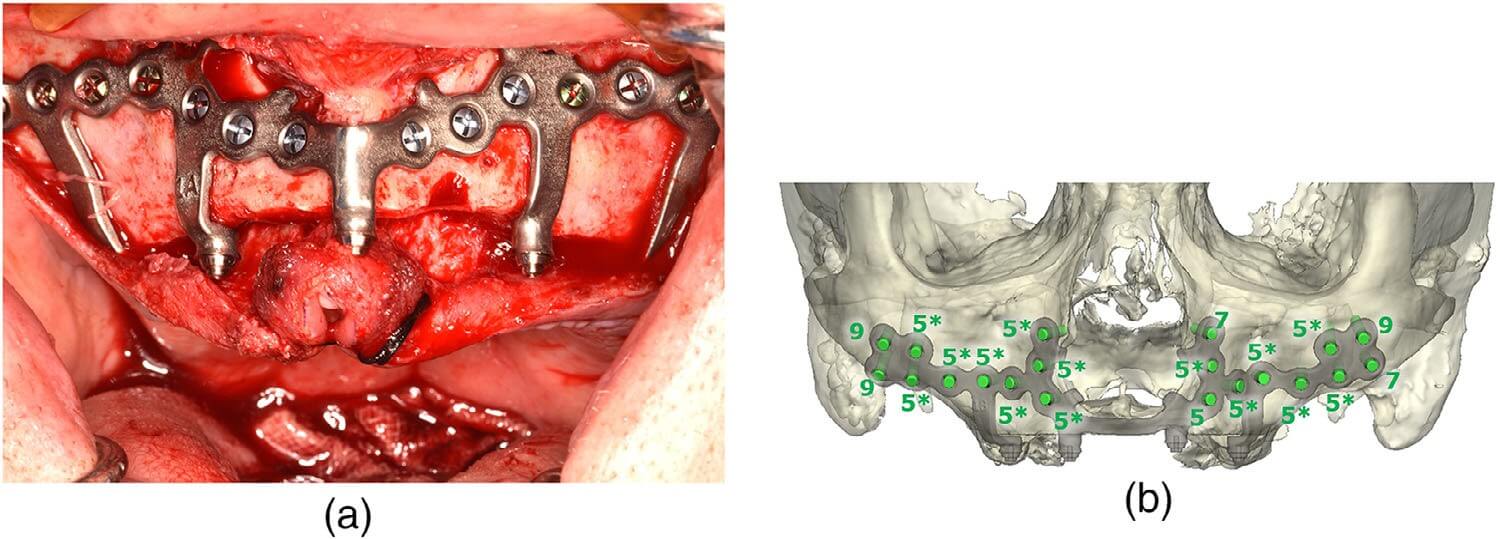 Patient-specific subperiosteal implant secured with titanium screws