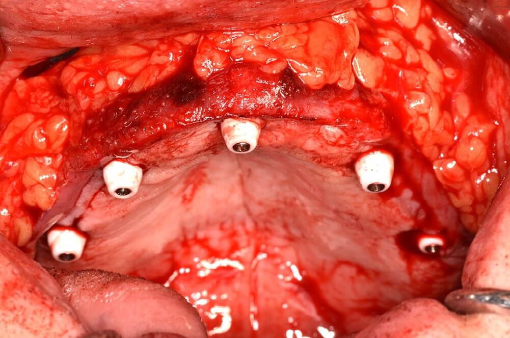 Soft tissue punched for MU abutment exposure