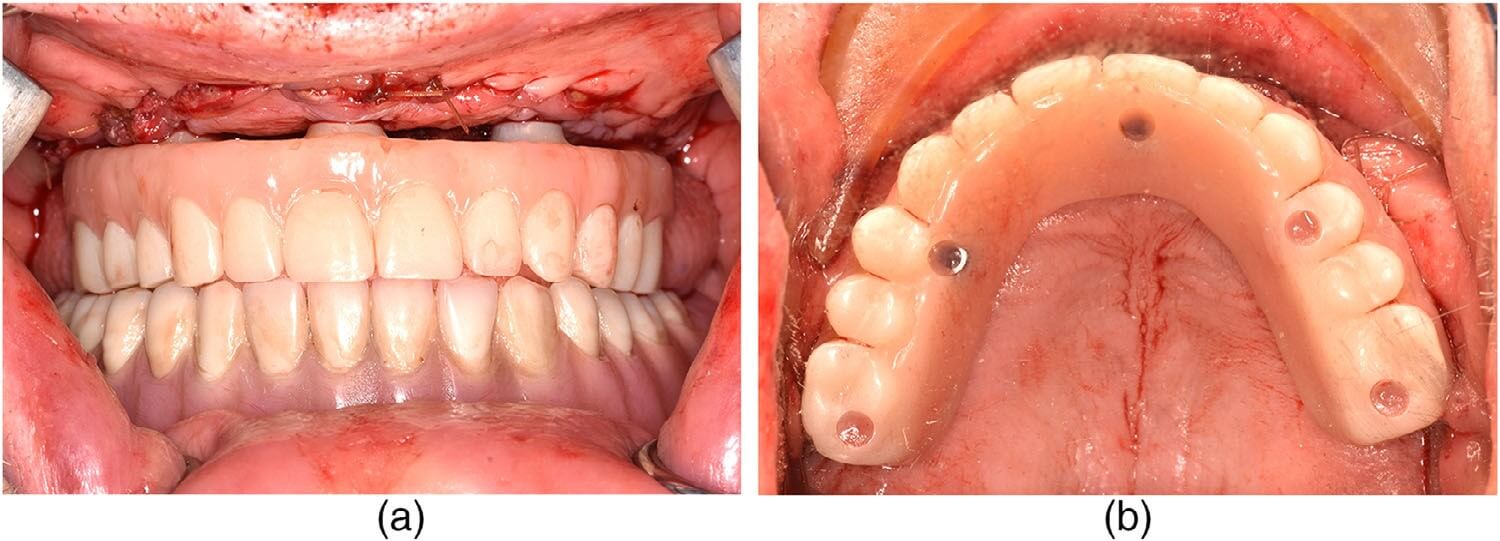 Wound closure and immediate insertion of provisional restoration
