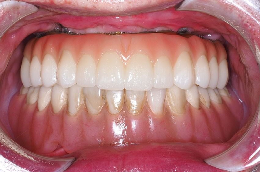 Definitive zirconia restoration at 4.5 months